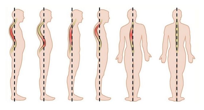 Trastornos posturais como causa de osteocondrose torácica