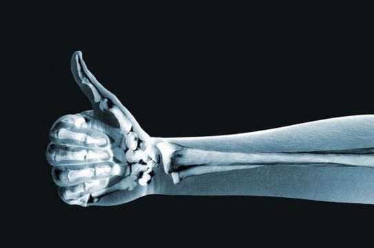 Os raios X poden ser útiles para diagnosticar a dor nas articulacións dos dedos